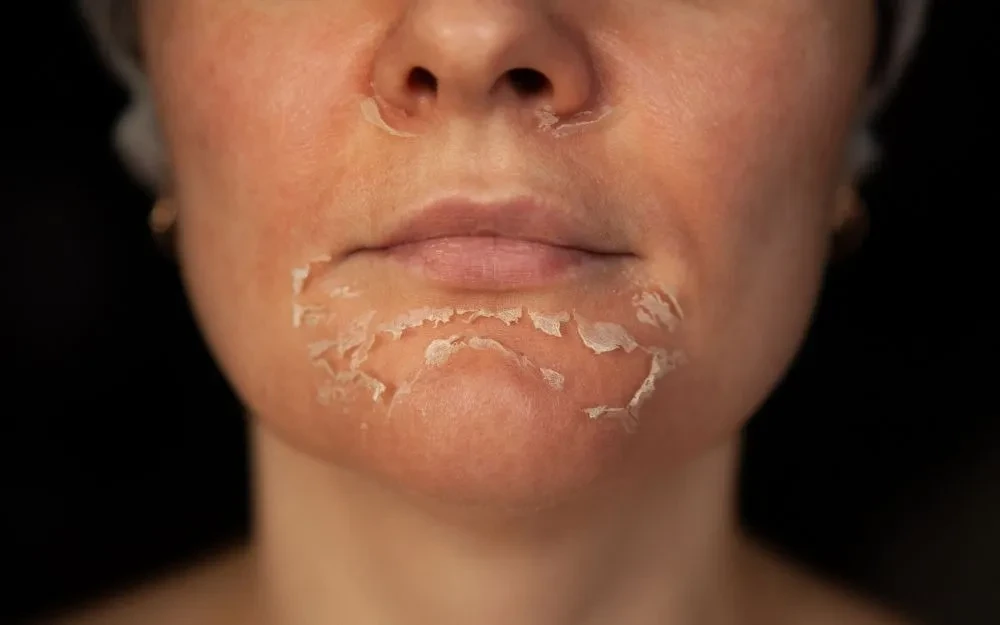 Làm sao để peel da an toàn mà không làm mỏng da?