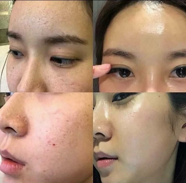 Da mỏng sau peel có dấu hiệu gì, cách phục hồi ra sao?