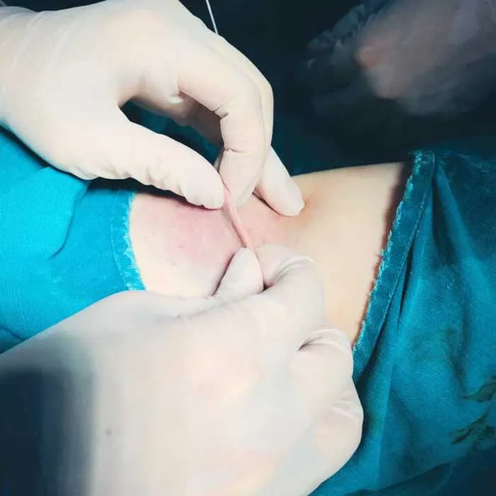 Chi phí bổ sung khi cắt tuyến mồ hôi nách?