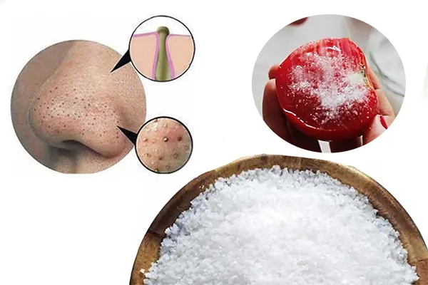 Trị mụn đầu đen bằng hóa chất an toàn như thế nào?