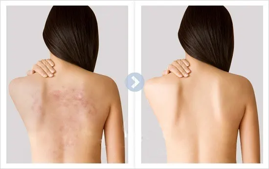 Chăm sóc mụn lưng hằng ngày để duy trì hiệu quả ra sao?