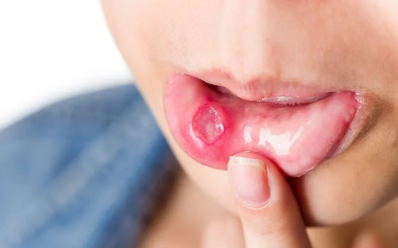 Thiếu kẽm gây ra triệu chứng gì xuất phát từ đâu?