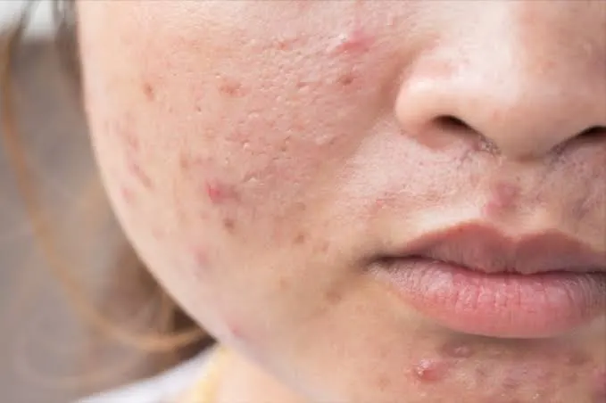 Làm sao duy trì kết quả sau khi cải thiện ăn đồ ngọt nhiều có gây mụn không?