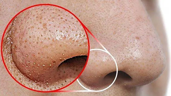 Mụn đầu đen ở mũi hình thành từ đâu?