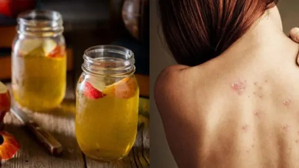 Sản phẩm nào phù hợp để trị mụn lưng?