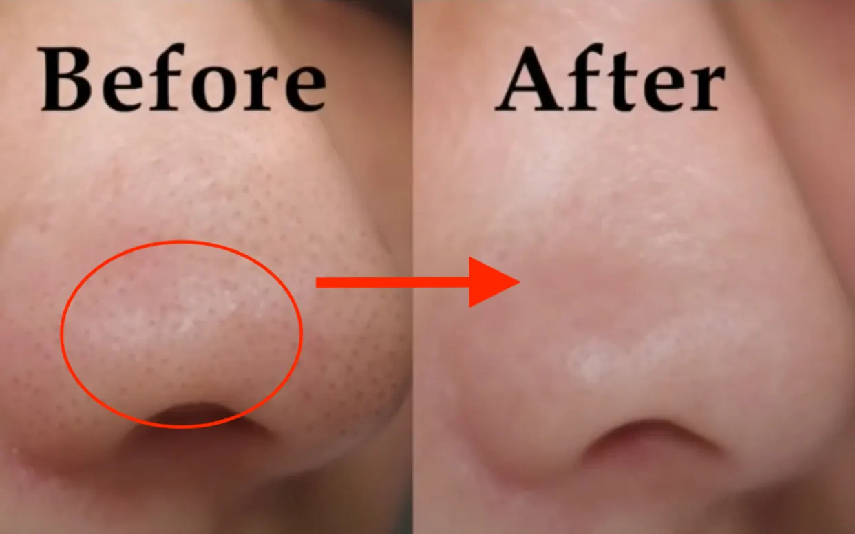 Tại sao không nên tự nặn mụn đầu đen?