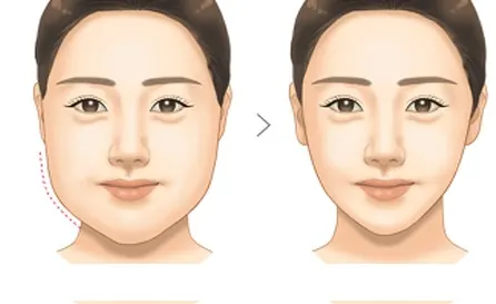 Hiểu lầm phổ biến về giảm mỡ mặt?