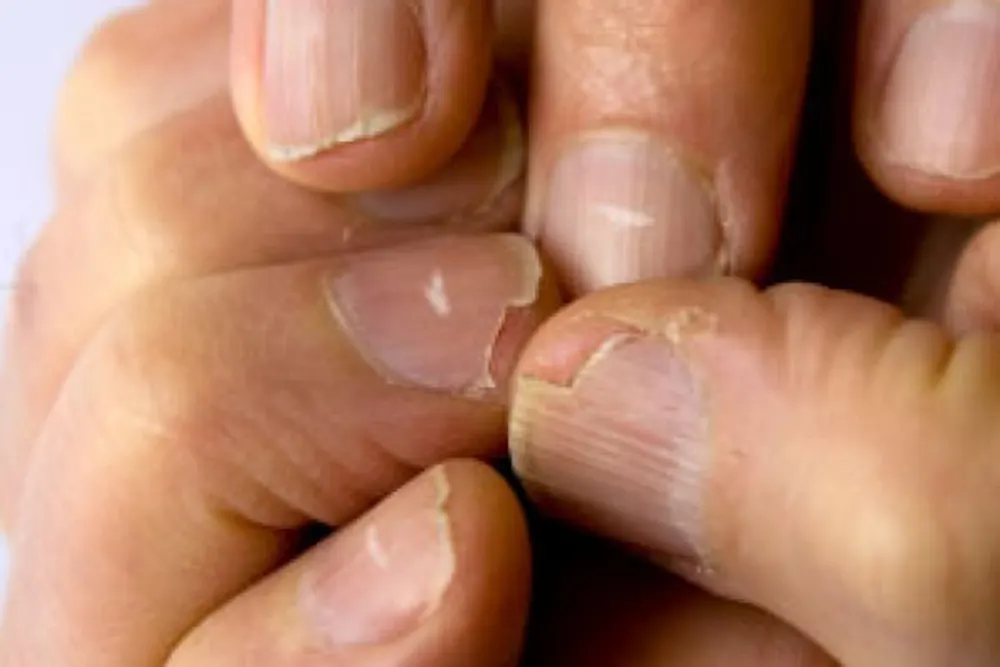 Thiếu kẽm gây ra triệu chứng gì có nguy hiểm không?