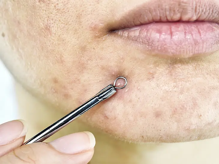 Thâm mụn là gì và tại sao lâu năm?