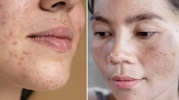 Làm gì trước khi xử lý cách trị da xỉn màu thiếu sức sống?