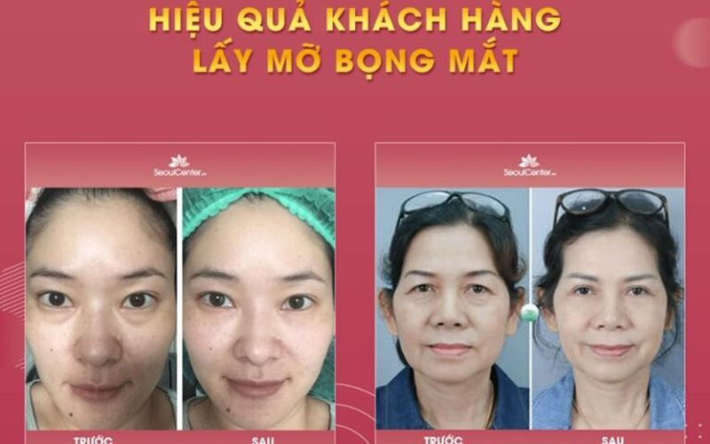 Khách hàng lấy mỡ mí mắt trên - dưới kết hợp trẻ hóa tại Seoul Center