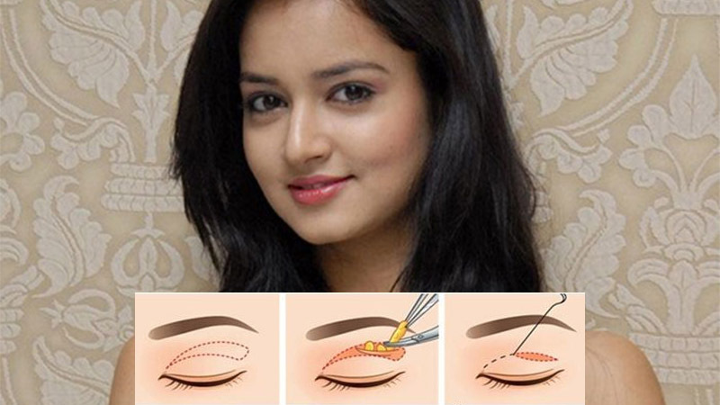 Cắt mí Ấn Độ giúp bạn sở hữu đôi mắt to, tròn, mí đều và loại bỏ được cả những phần mỡ, da thừa.