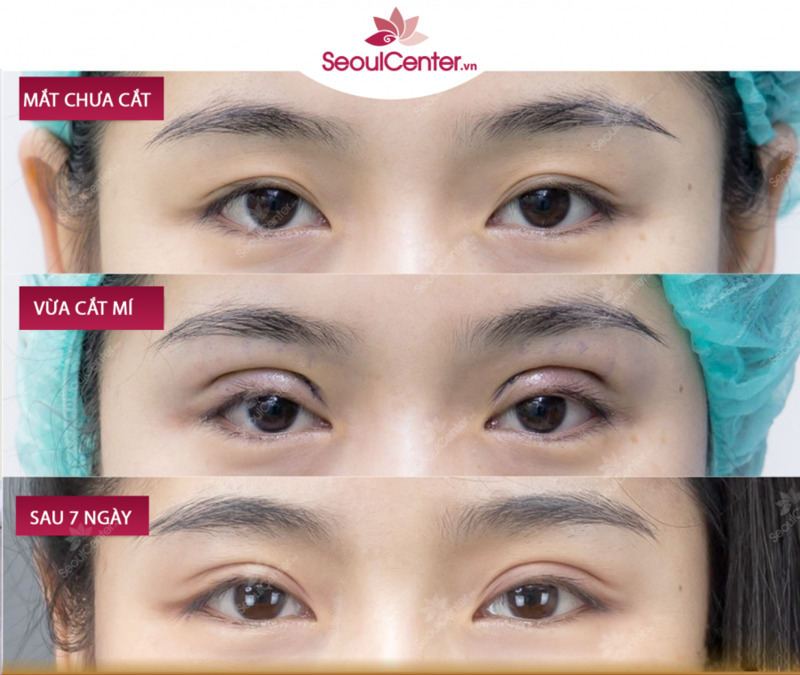 Cắt mí Ấn Độ là một tiểu phẫu đơn giản nên sẽ không gây ra đau đớn