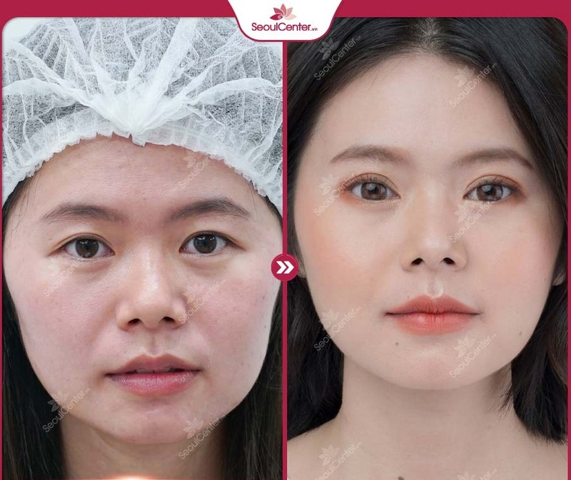 Sẹo cắt mí Ấn Độ rất nhỏ, nằm dưới nếp gấp và mờ dần theo thời gian nên rất khó có thể phát hiện ra.