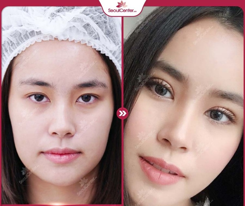 Những người có khuyết điểm mắt một mí, mắt mí lót là những người nên cắt mí ấn độ