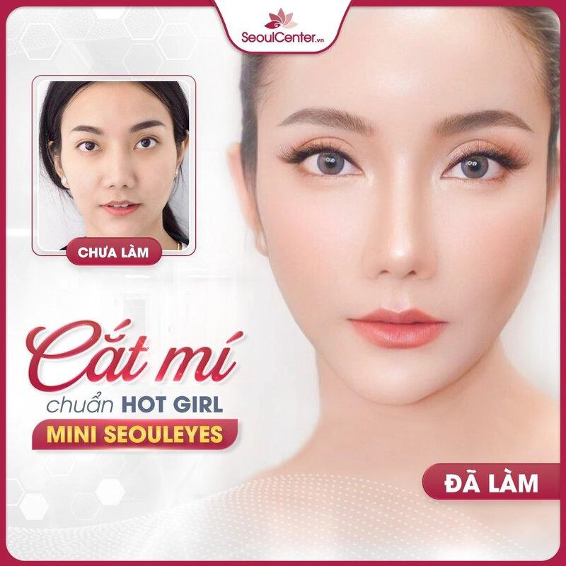 Nhan sắc xinh đẹp, quyến rũ của khách hàng sau khi cắt mí tại Seoul Center