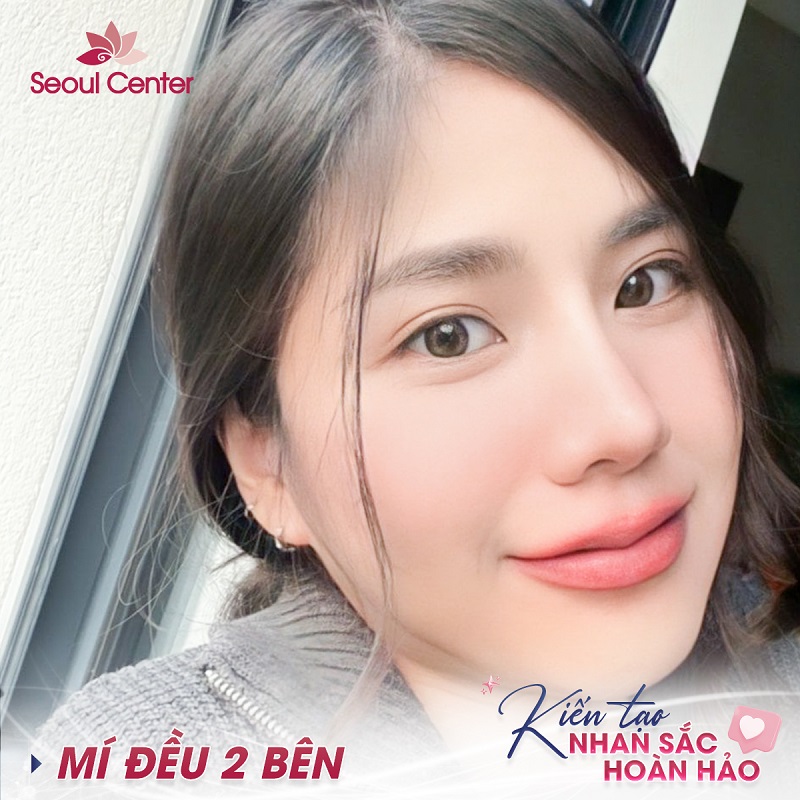 Cắt mí mini deep 6D đạt 6 tiêu chuẩn nổi bật
