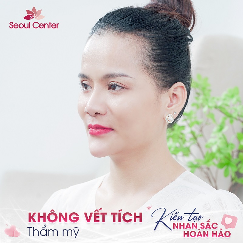 Thời gian duy trì nếp mí còn phụ thuộc vào cơ địa, công nghệ cắt mí