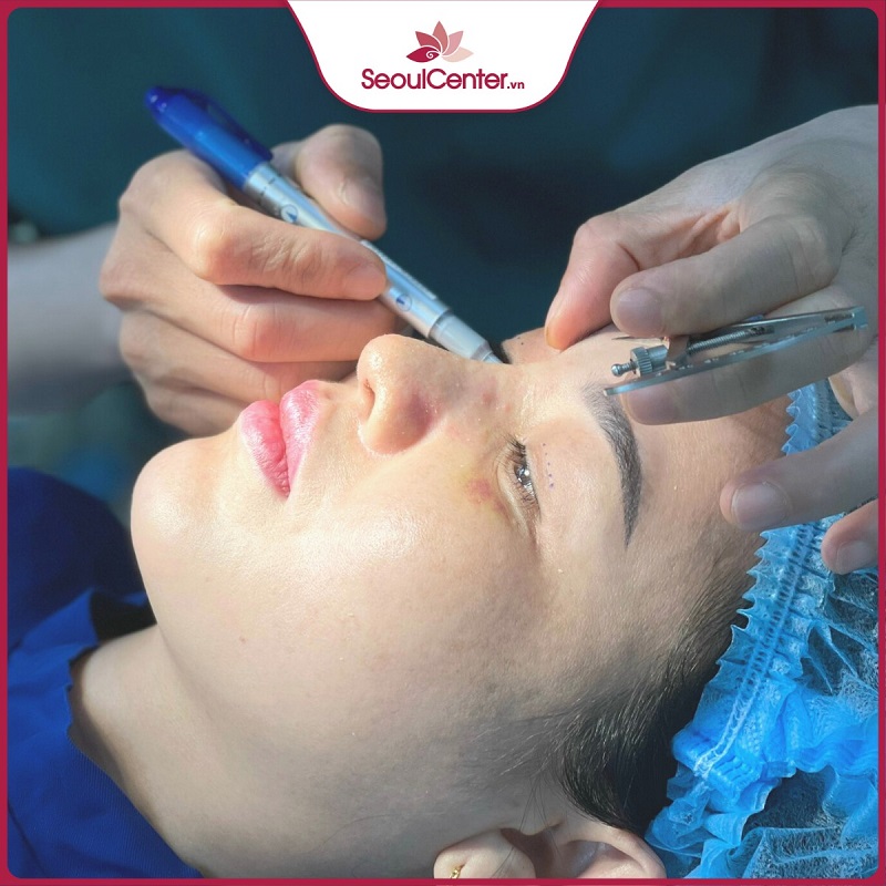 Hiện nay giá cắt mí nội soi trên thị trường dao động từ 8 đến 12 triệu đồng