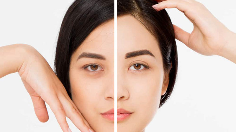 Nâng cung chân mày là phương pháp hiện đại giúp kéo căng vùng chân mày