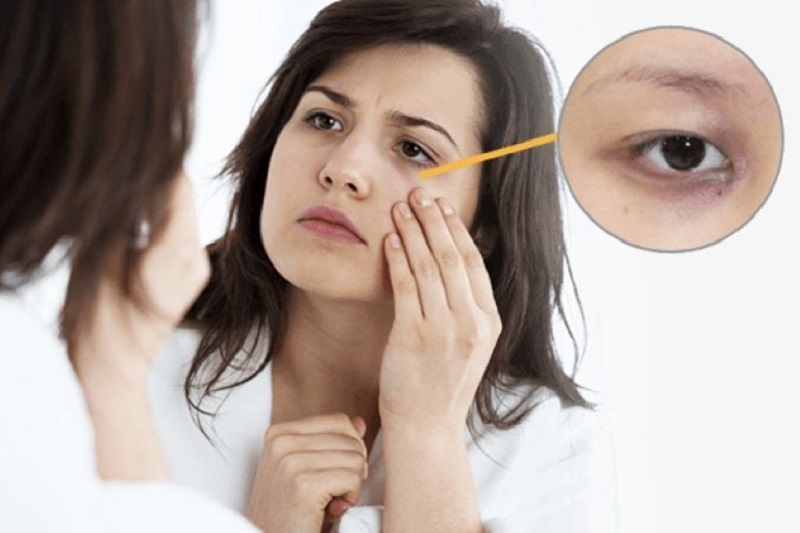 Thiếu ngủ là nguyên nhân khiến đôi mắt lờ đỡ, buồn bã