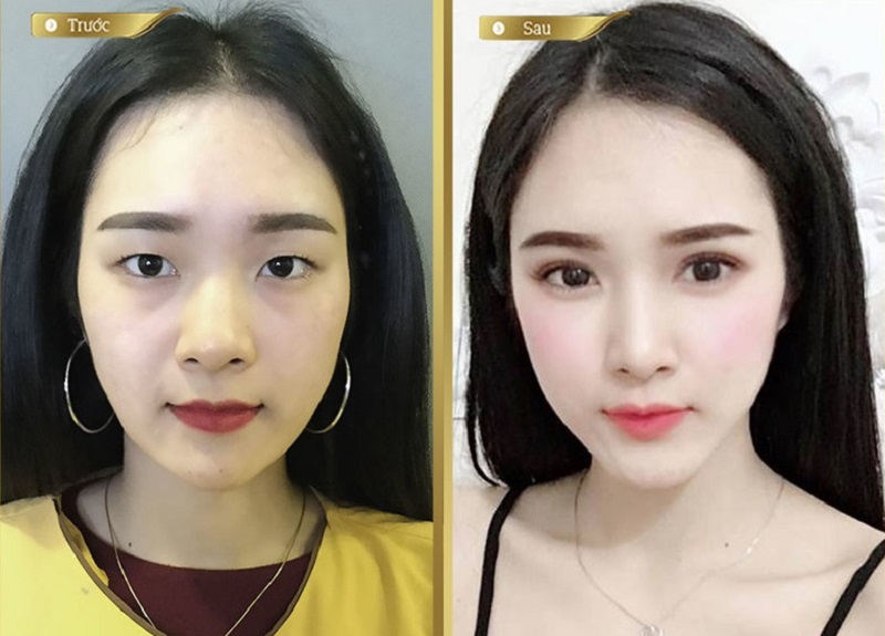Nâng cơ mí mắt chữa sụp mí, mang lại đôi mắt trẻ trung