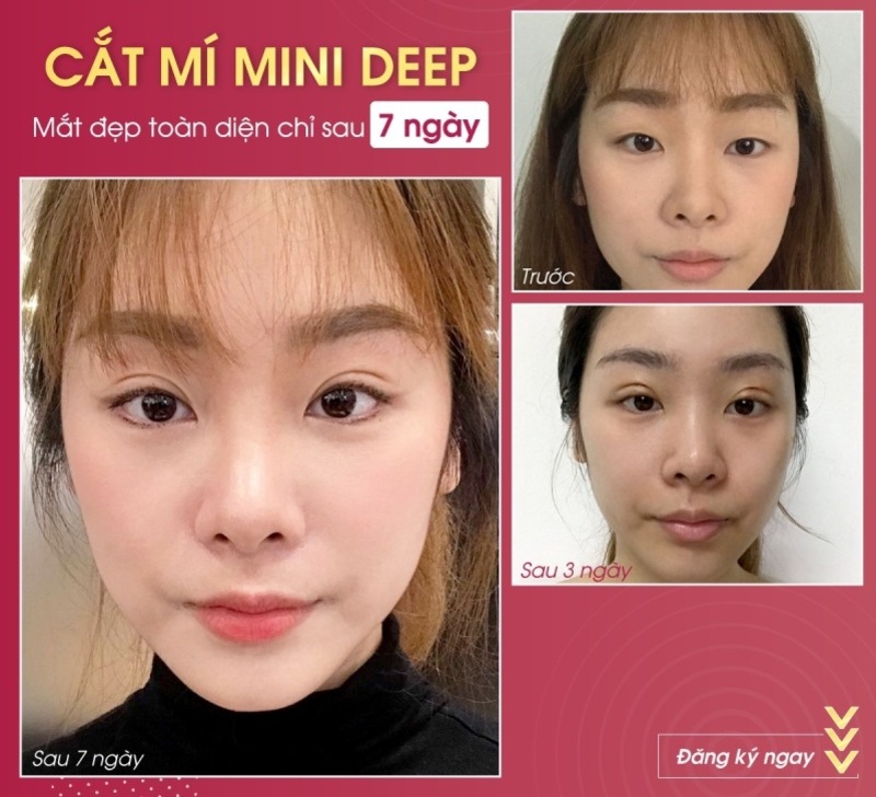 Nếp mí rõ nét, tự nhiên của khách hàng sau khi cắt mí tại Seoul Center