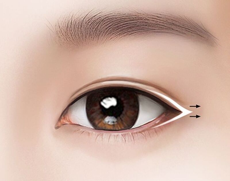 Mở tròng mắt là phương pháp an toàn, hiệu quả giúp chị em sở hữu đôi mắt to, ấn tượng
