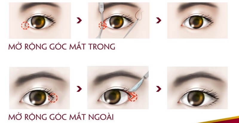 Các thao tác và vị trí thực hiện mở góc mắt trong và ngoài