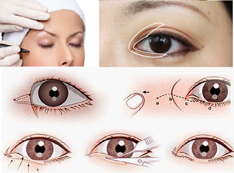 Kết quả mở góc mắt có thể duy trì lên tới 20 năm
