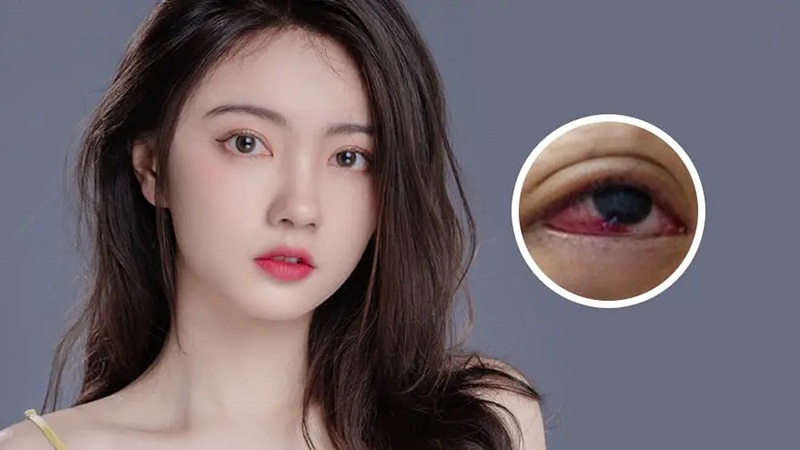  Mắt sưng viêm là biến chứng nguy hiểm nếu thực hiện mở góc mắt theo quy trình không đảm bảo vệ sinh