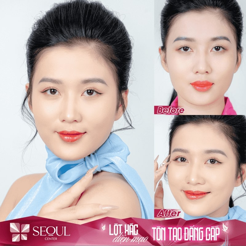 Khách hàng lột xác với đôi mắt xinh đẹp, tự nhiên sau khi nâng cơ mí