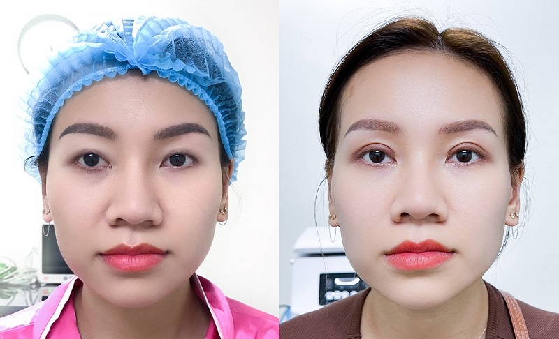 Cắt mí đem lại đôi mắt hai mí to, tròn và long lanh hơn
