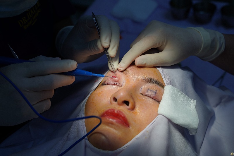 Lựa chọn thẩm mỹ viện Đông Á để có đôi mắt hai mí vạn người mê
