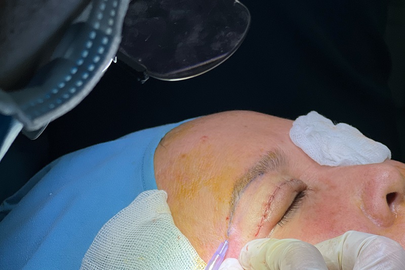 Lựa chọn viện thẩm mỹ Khơ Thị để khắc phục khuyết điểm mắt một mí