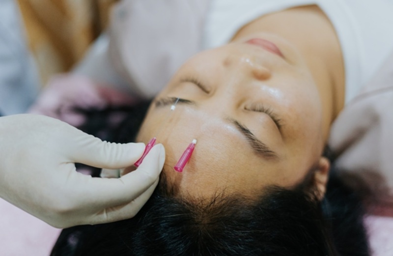 Có thể khắc phục tướng số người ngủ mở mắt bằng châm cứu