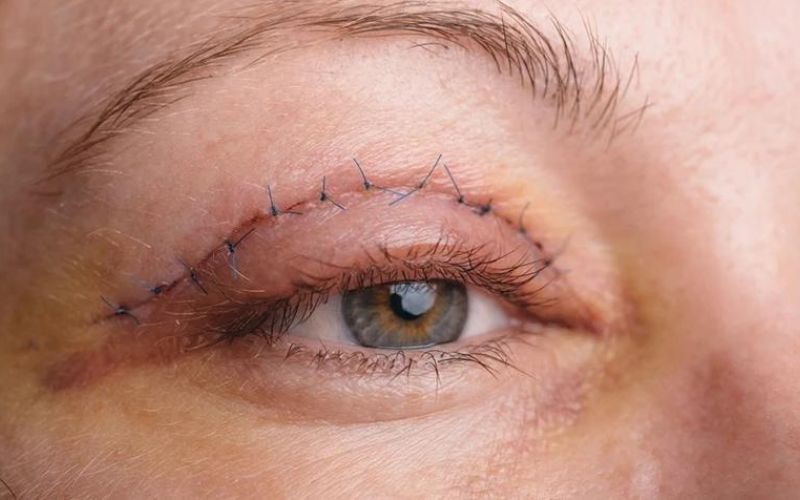 Trong mì tôm có chứa những thành phần gây sẹo mí mắt
