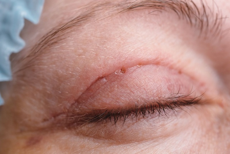 Hướng dẫn khách hàng xử lý đúng cách khi gặp biến chứng do cắt mí hỏng