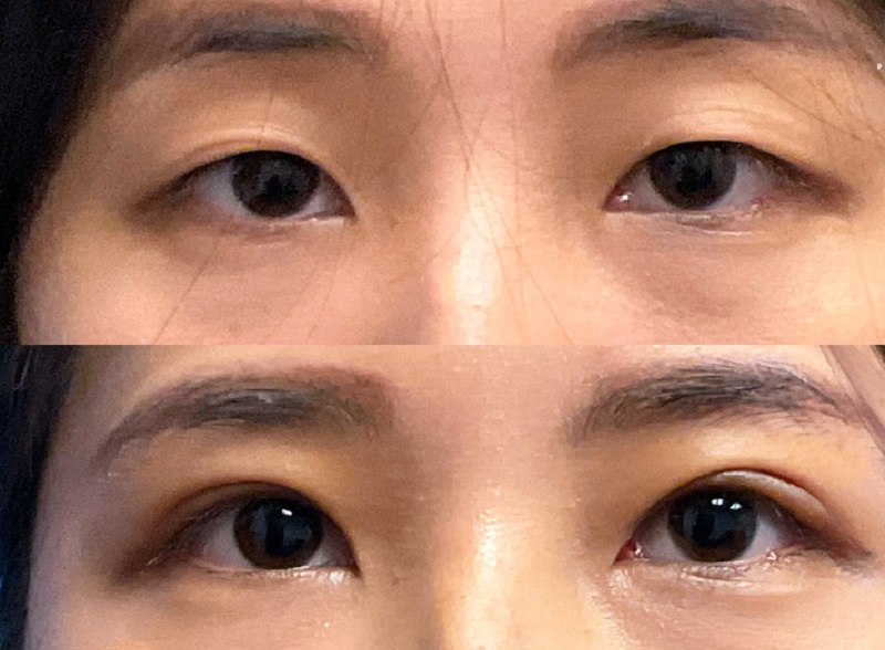Mắt không đều, bị trợn là biểu hiện của biến chứng phẫu thuật cắt mí