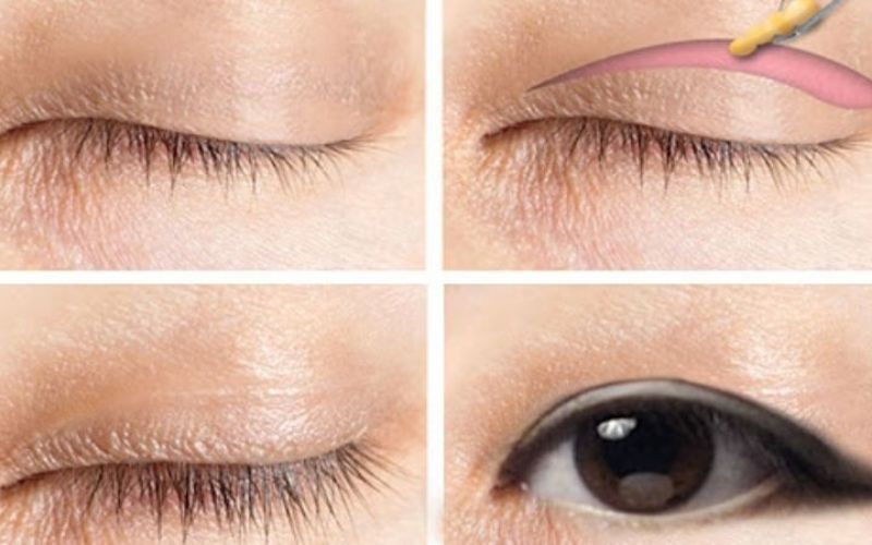 Phương pháp cắt mí mắt hiện đại có độ an toàn cao