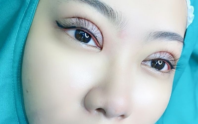 Không nên cắt mí quá to sẽ làm cho đôi mắt trông dữ tợn
