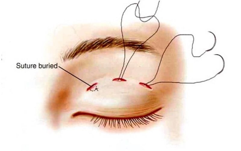 Bấm mí cũng là một phương pháp tạo hình mắt 2 mí, có cách thực hiện đơn giản hơn so với cắt mí