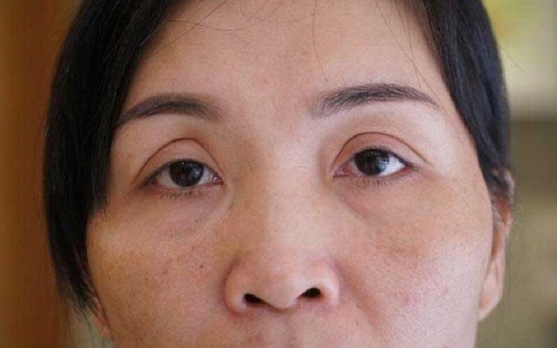 Cắt mí mắt giá rẻ tiềm ẩn nhiều nguy cơ gây hỏng nếp mí