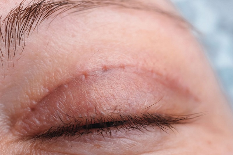 7 - 10 ngày mí mắt sẽ dẫn hồi phục nhưng vẫn cần kiêng cữ kỹ lưỡng