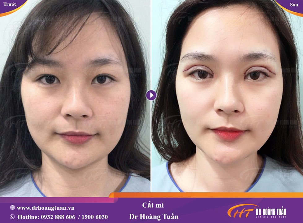 Thẩm mỹ viện Hoàng Tuấn mang đến dịch vụ cắt mí an toàn, hiệu quả