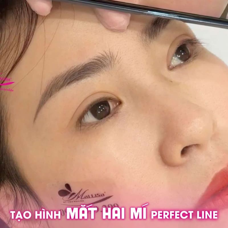 Thẩm mỹ viện Mailisa ứng dụng công nghệ cắt mí hiện đại