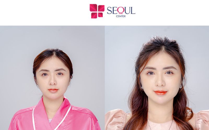 Kết quả cắt mí của khách hàng tại Seoul Center được đánh giá là đẹp và sắc nét