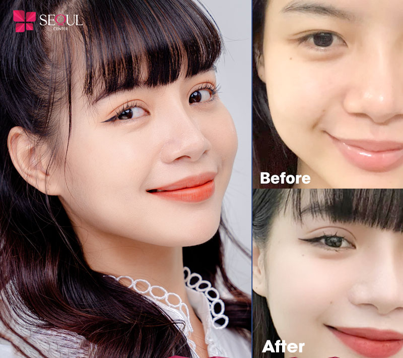 Thẩm mỹ viện của bác sĩ Nguyễn Văn Tường với công nghệ cắt mí plasma