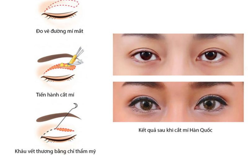 Thẩm mỹ Thu Hương đã giúp nhiều khách hàng cắt mí thành công