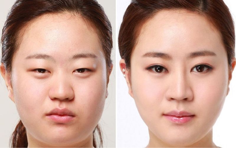 Góc mắt trong sau khi được mở rộng giúp cho đôi mắt to hơn, hài hoà với khuôn mặt